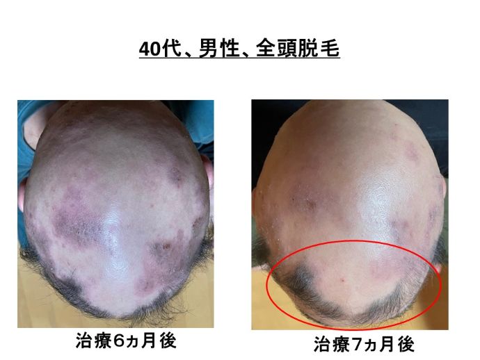 円形脱毛症　病院